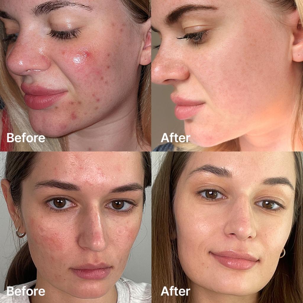 Red Succinic Acid Serum - Απολεπιστικός Ορός Κατά της Ακμής με Νιασιναμίδη & Σουξινικό Οξύ