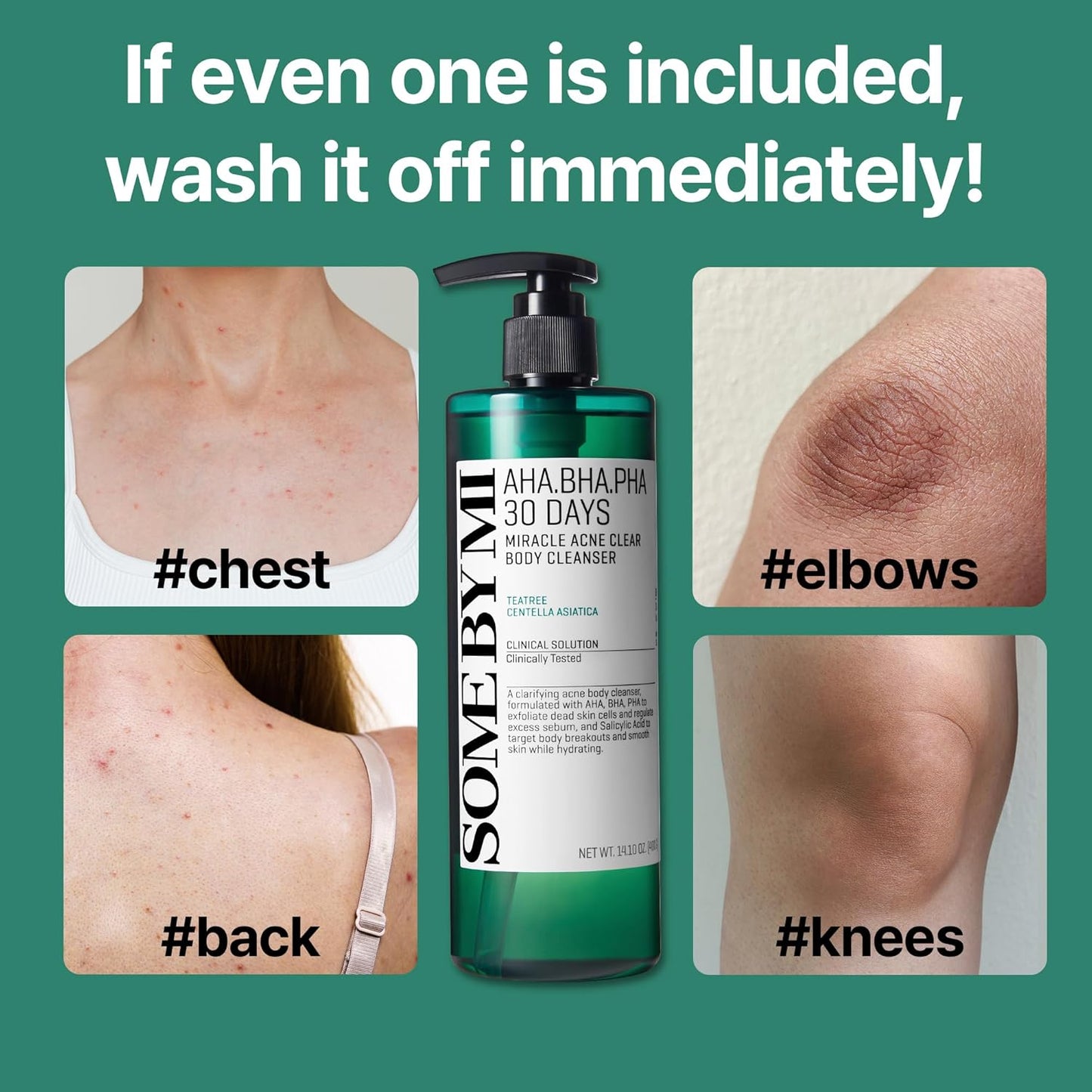AHA-BHA-PHA 30 days Miracle Acne Body Cleanser - Καθαριστικό Σώματος Κατά της Ακμής