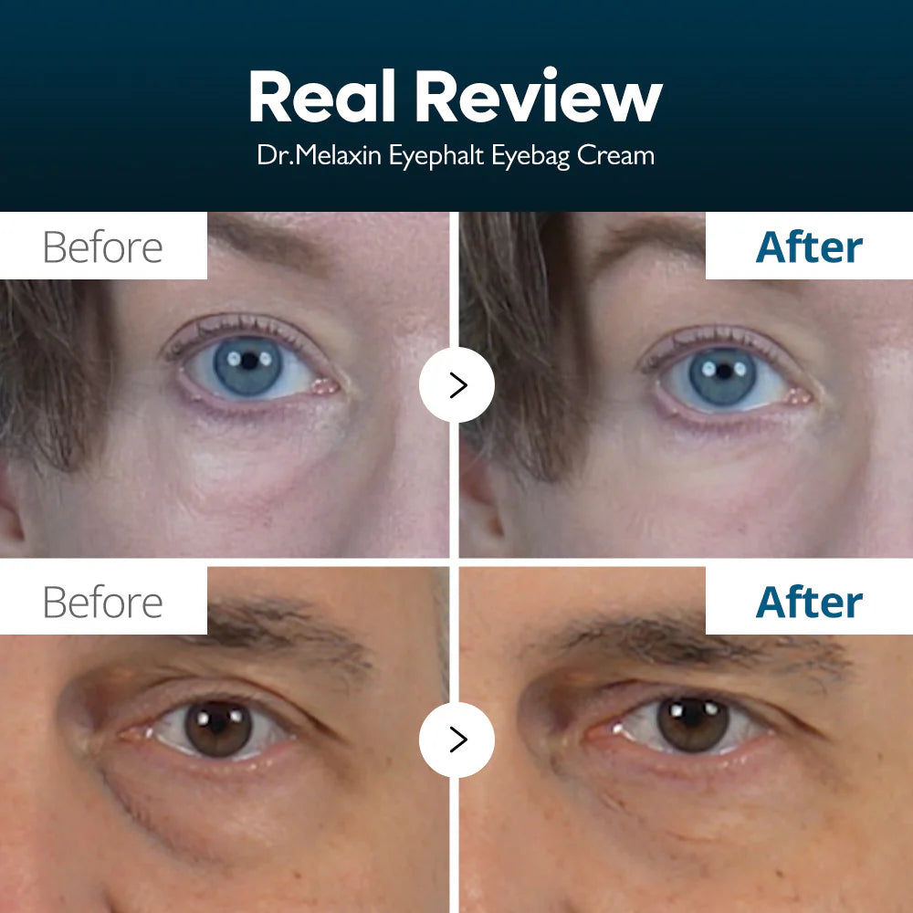 Eyephalt Eyebag Cream - Κρέμα Ματιών για Σακούλες & Μαύρους Κύκλους