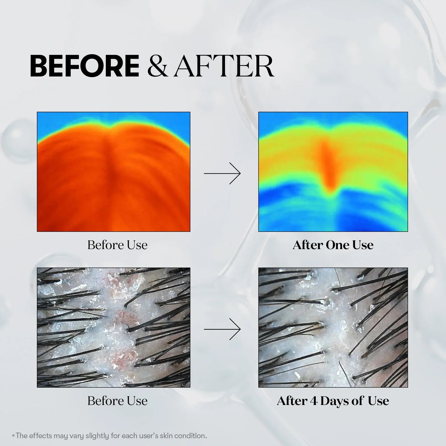 PDRN Reedle Shot Hair Ampoule 700dL – Ενισχυτική Αμπούλα Τριχωτού Υψηλής Συγκέντρωσης για Τριχόπτωση & Ανάπτυξη Μαλλιών