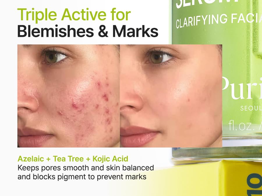 Azelaic Acid 10 Kojic Tea Tree Serum - Καθαρισμός Ακμής & Σημαδιών