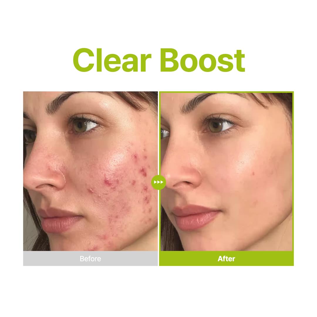 Azelaic Acid 10 Kojic Tea Tree Serum - Καθαρισμός Ακμής & Σημαδιών