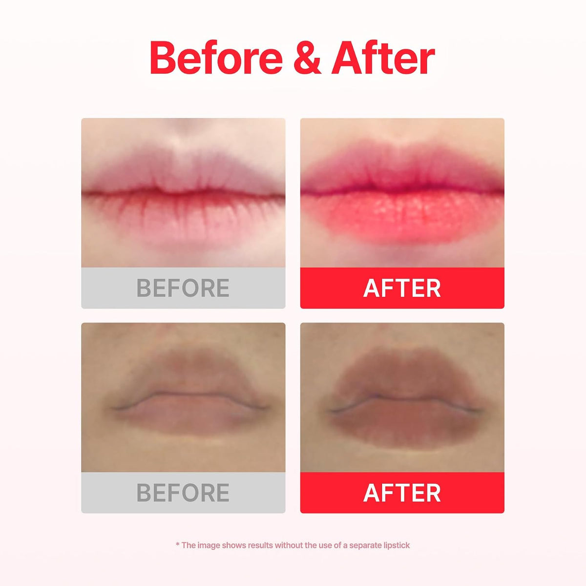JOLLY FILLY Lip Plumping Patch – Microneedle Patch Χειλιών για Όγκο & Ενυδάτωση