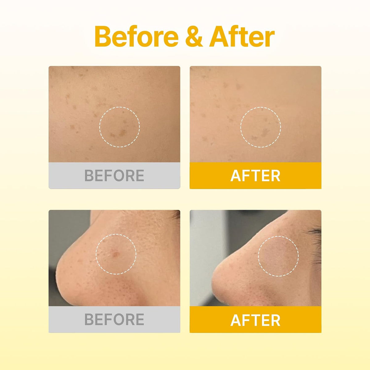 Dark Spot Care Microcone Patch – Microcone Patches για Πανάδες, Κηλίδες & Ανομοιόμορφο Τόνο