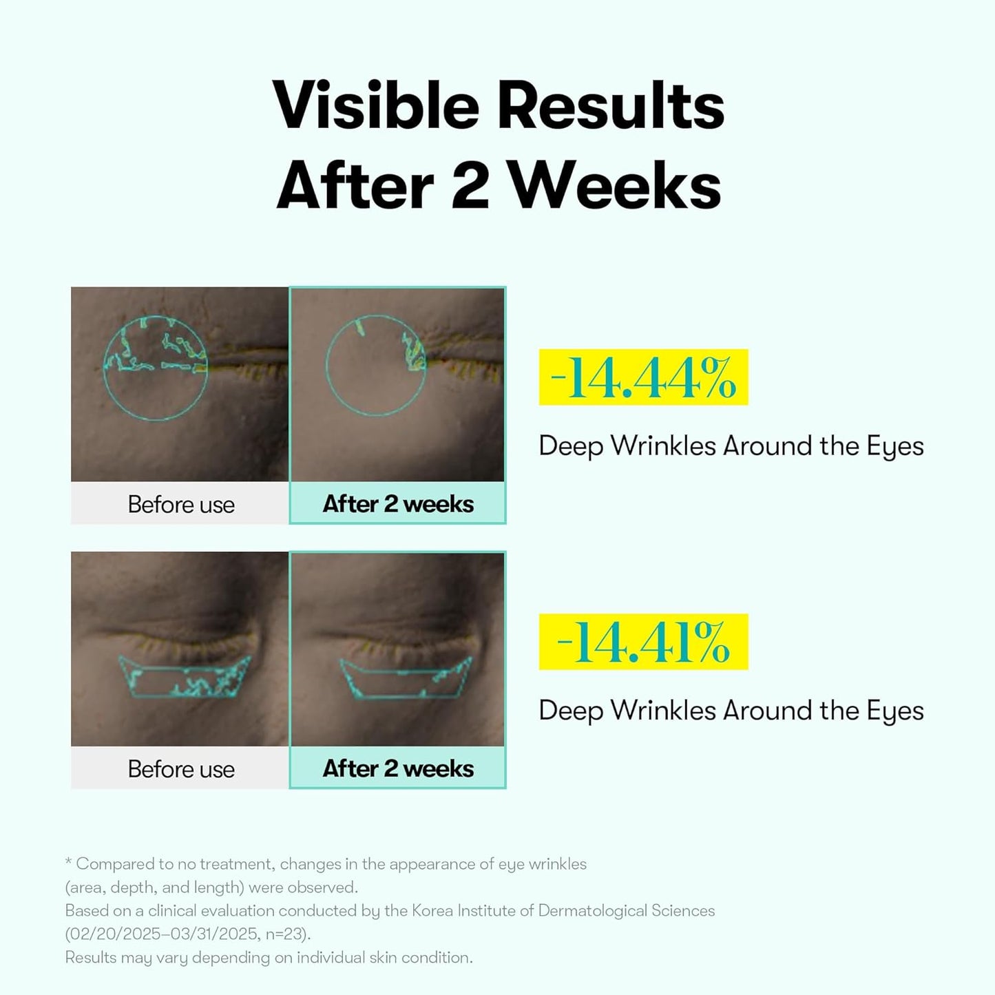 PDRN Reedle Shot Eye Lifter – Συσφιγκτική Κρέμα Ματιών για lifting με Δονούμενο Applicator