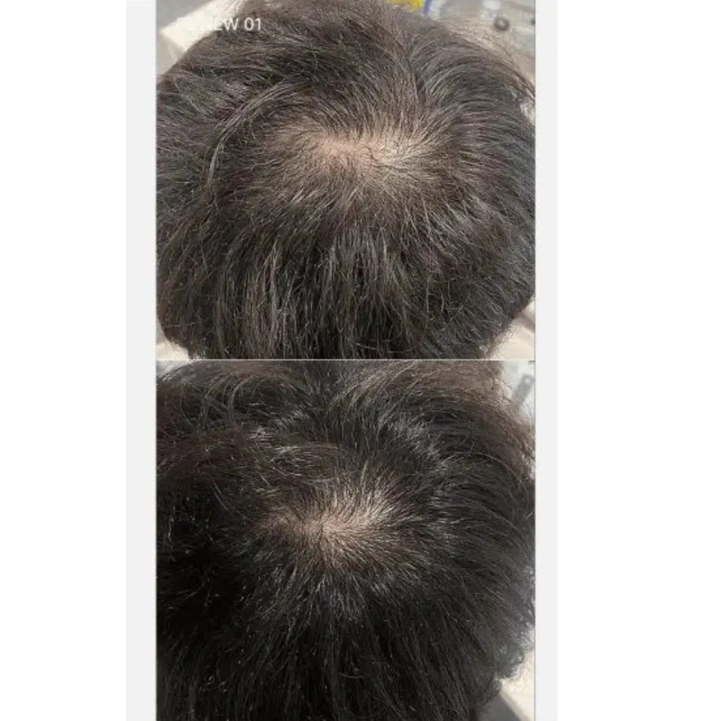 SOYXIDIL Shampoo - Σαμπουάν κατά της τριχόπτωσης